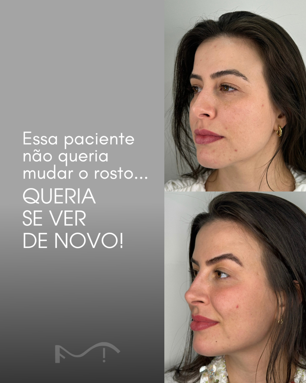 Essa paciente não queria mudar o rosto, QUERIA SE VER DE NOVO!